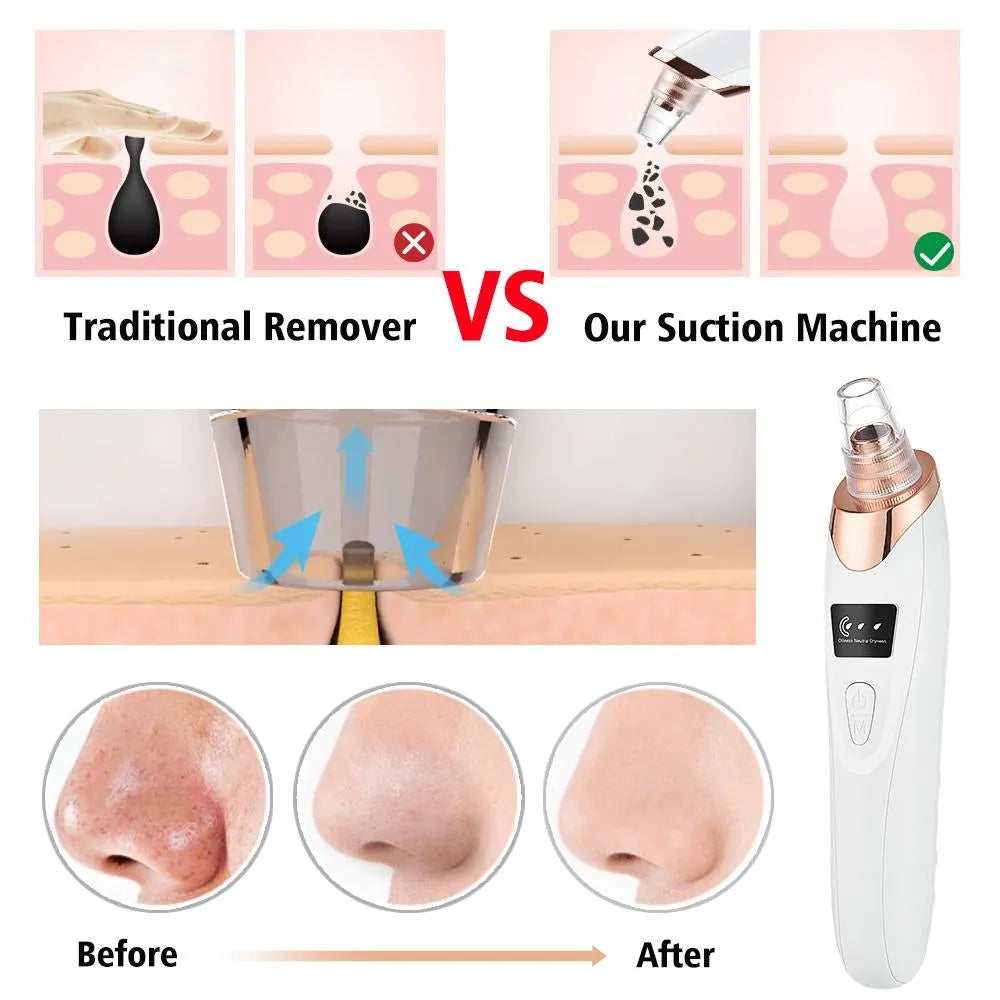 5-in-1 Blackhead remover, blackhead remover machine, derma suction, pimple acne remover