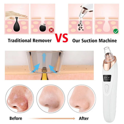 5-in-1 Blackhead remover, blackhead remover machine, derma suction, pimple acne remover